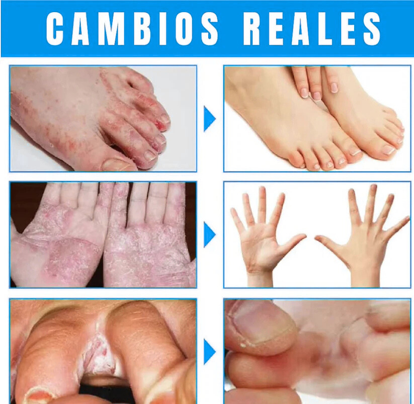 Spray AntiHongos